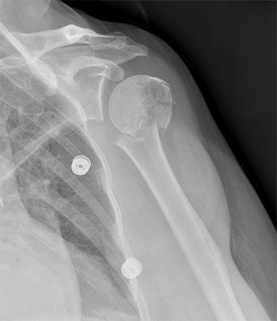 Shoulder Fracture - Picture