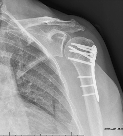 Shoulder Fracture - Picture